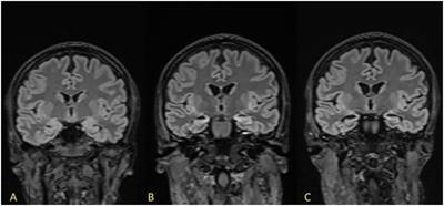 Amnestic syndrome in the course of seronegative limbic encephalitis complicated by drug-resistant epilepsy: a case report